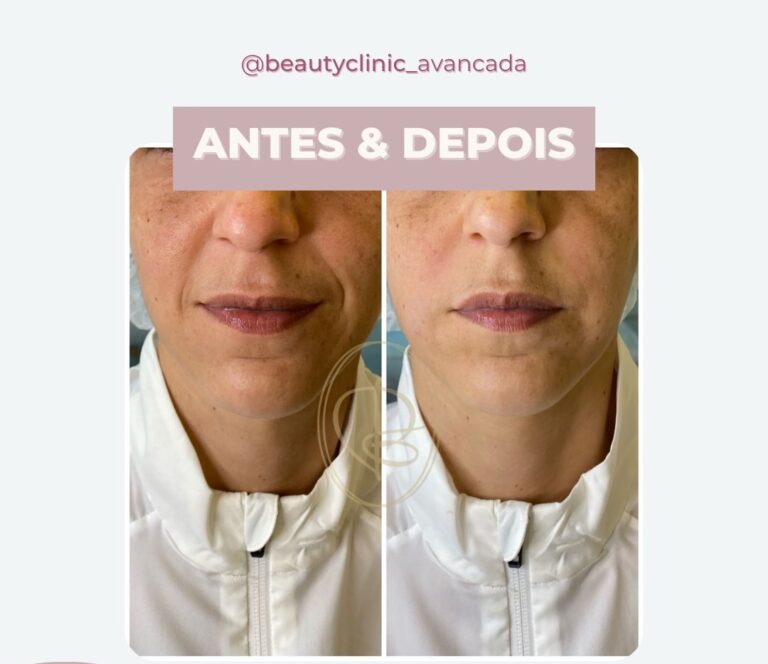 Antes e depois