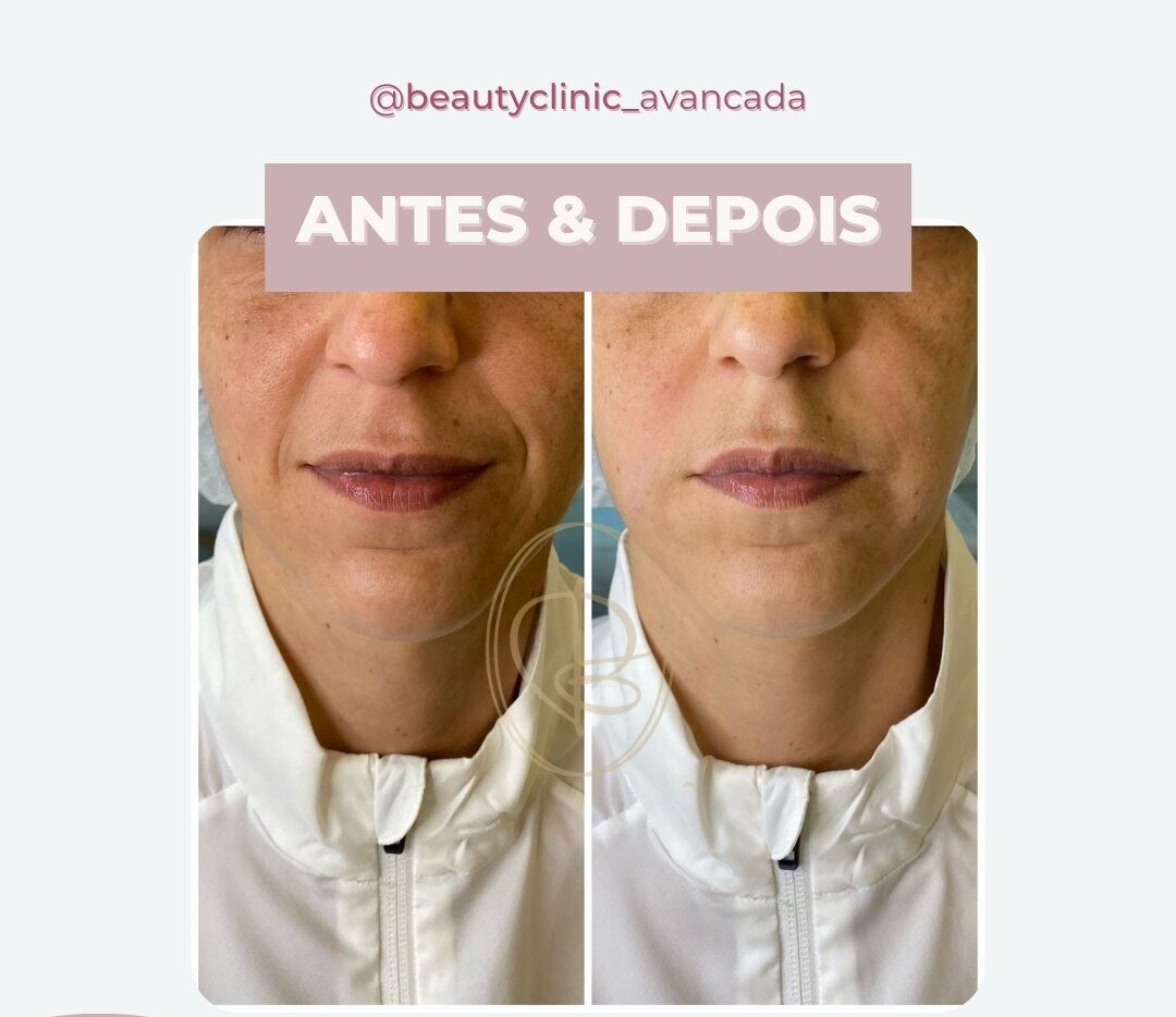Antes e depois