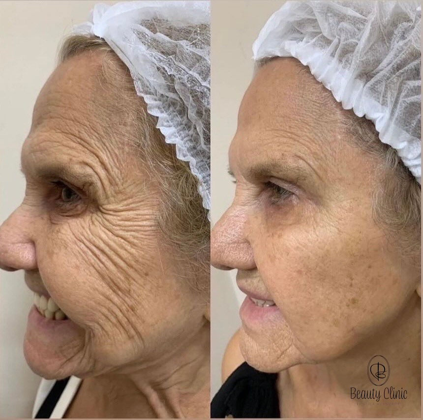 Resultado de rejuvenesc