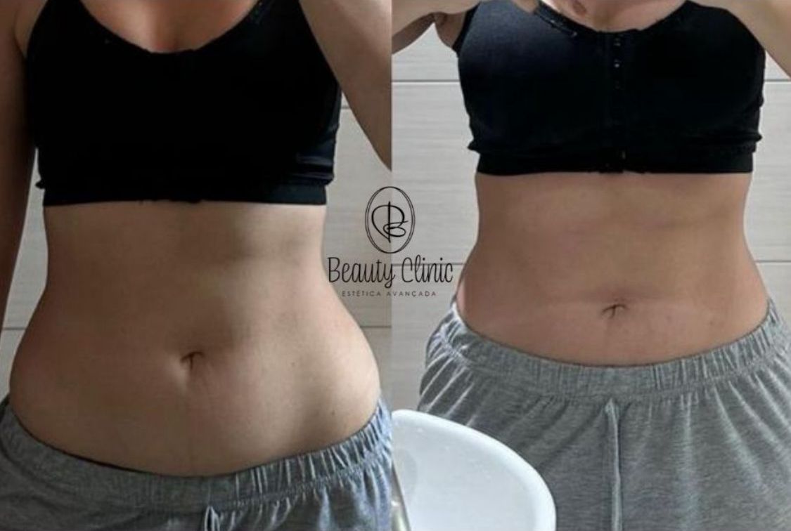 Antes e depois