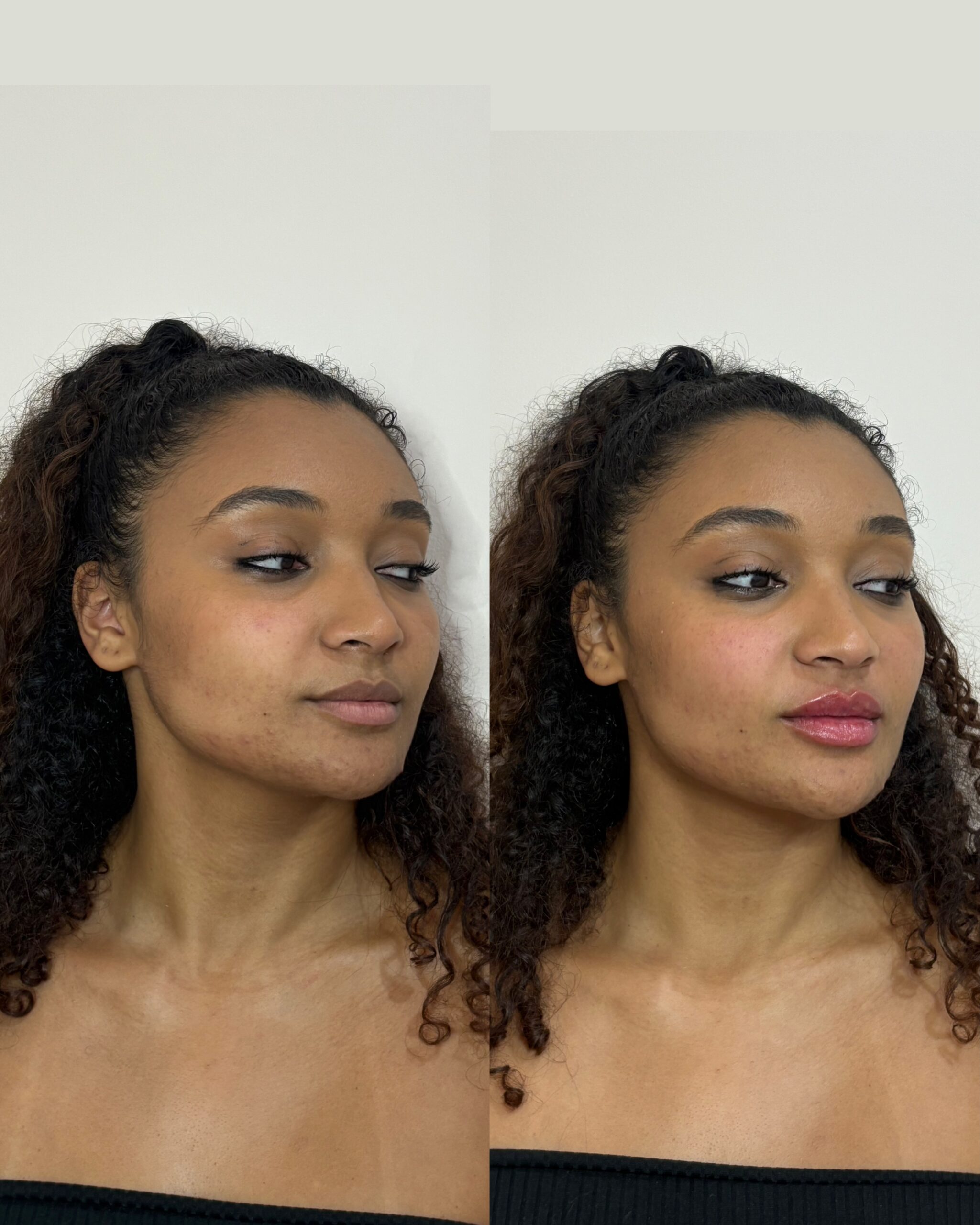 Preenchimento Labial no Campo Limpo - SP | Beauty Clinic Estética
