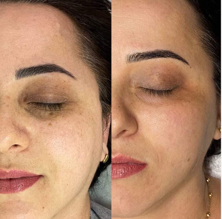 Lavieen para Manchas e Rejuvenescimento em Campo Limpo | Beauty Clinic